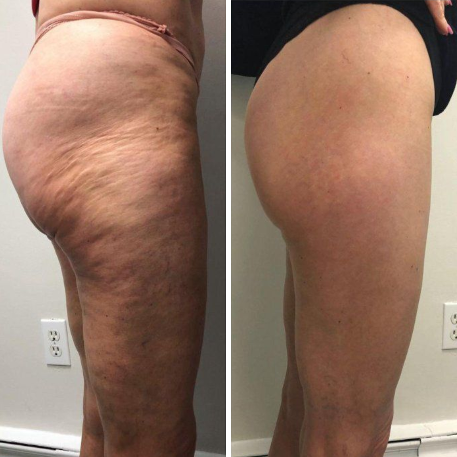 Negusy™ PDRN-GLP-1 Microneedle Slimming & Sculpting Gel