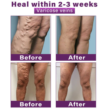 ✅Seurico™ Polidocanol Nano Varicose Vein Patch Recommended by the Society for Vascular Surgery