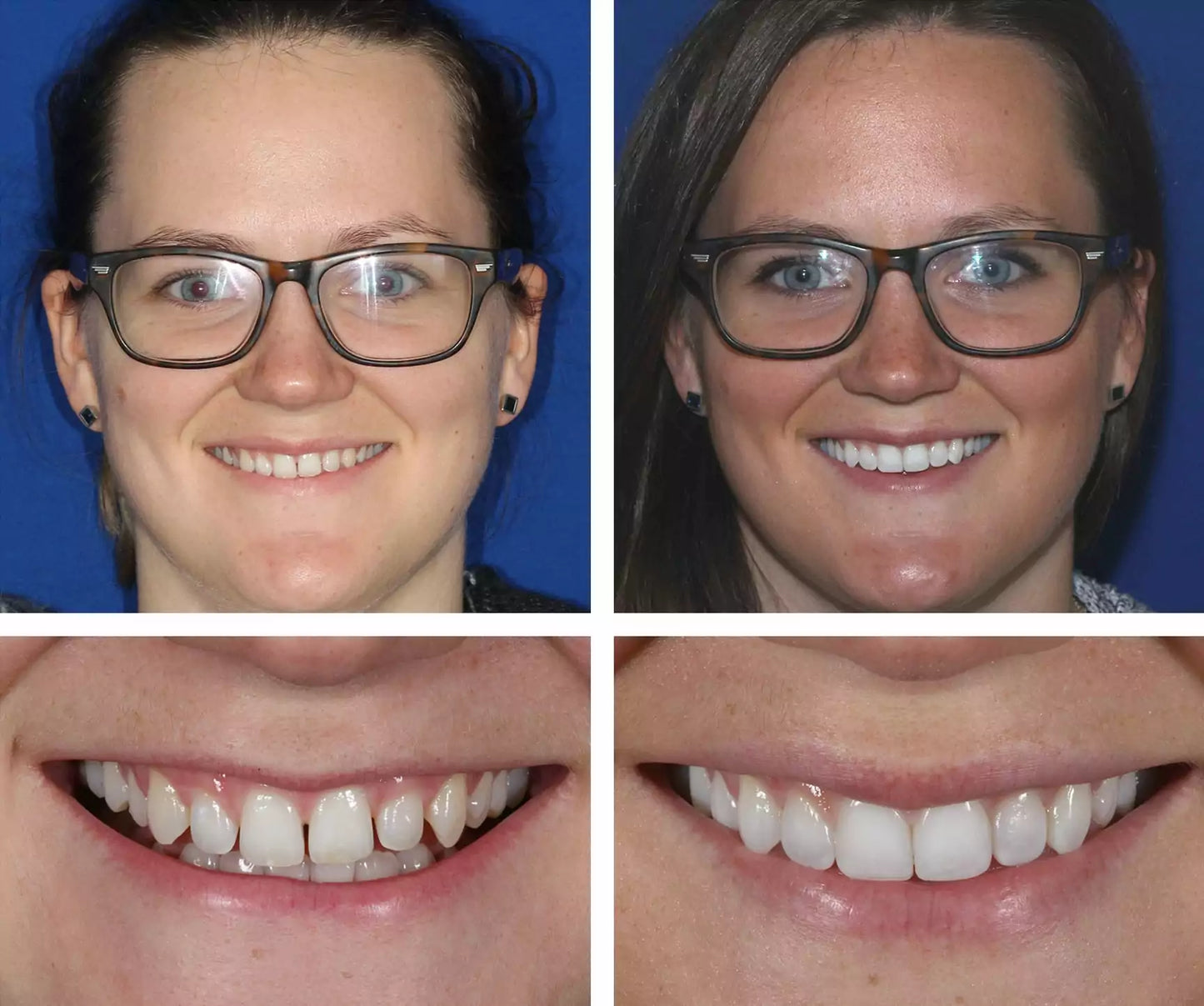 Seurico™ Instant Tooth Repair Gel – No Drills, No Pain, Fast at Home Fix!