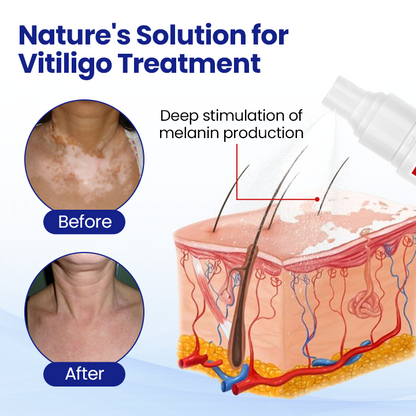 ODEIUN™ Vitiligo Treatment Spray 🌿 Fade Spots Restore Confidence 🌞