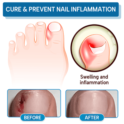 Lbmlbm® OnyxiGuard Fungal Repair Herbal Spray – 🌿 Natural Treatment for Healthy, Revitalized Skin & Nails ✨