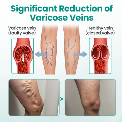 Seurico™ VeinRevive Leg Varicosity Treatment Patch