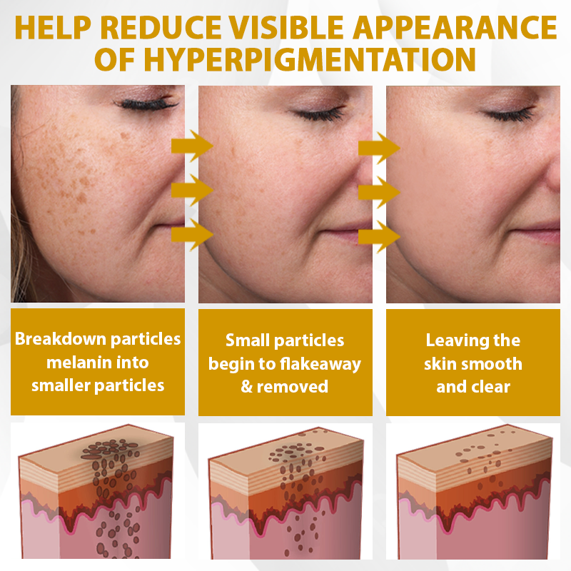 【🔥Last Day Promotion 45% OFF⚡】Seurico™ CastorBee Tag & Spots Peel-Off Mask