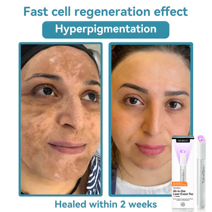 Seurico™ VelvetSkin+ All-in-One Laser Eraser Pen✨ | Safe & Easy At-Home Solution for Smooth, Spot-Free Skin 💆‍♀️🌟