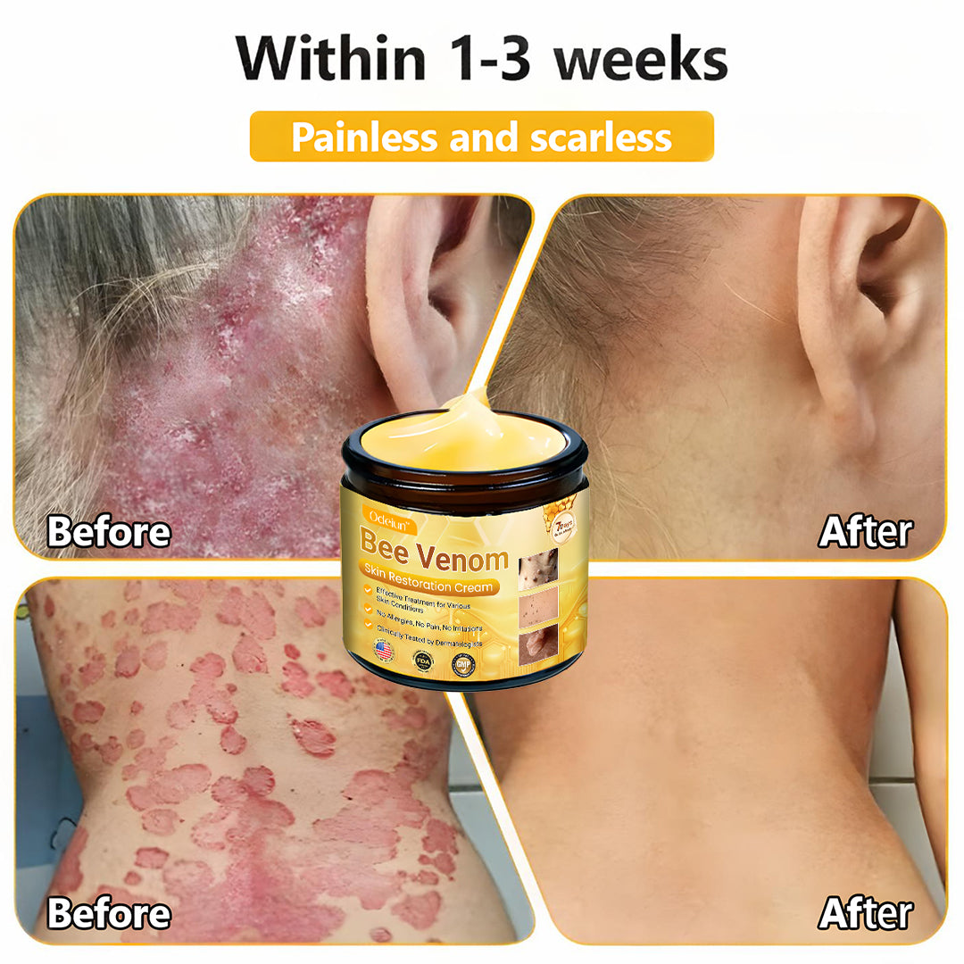 ✨ ODEIUN™ Bee Venom Skin Restoration Cream - Revitalize & Renew Your Skin Naturally! 🌿🐝