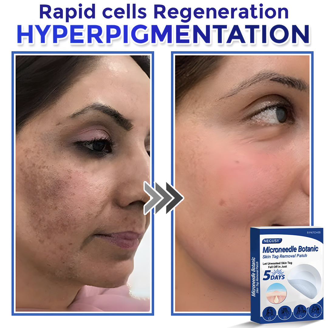 ✅Negusy™ MicroNeedle Botanic Skin Tag Removal Patches – 🇺🇸 Made in the USA | Fast, Painless, Plant-Powered