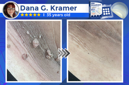 ✅Negusy™ MicroNeedle Botanic Skin Tag Removal Patches – 🇺🇸 Made in the USA | Fast, Painless, Plant-Powered