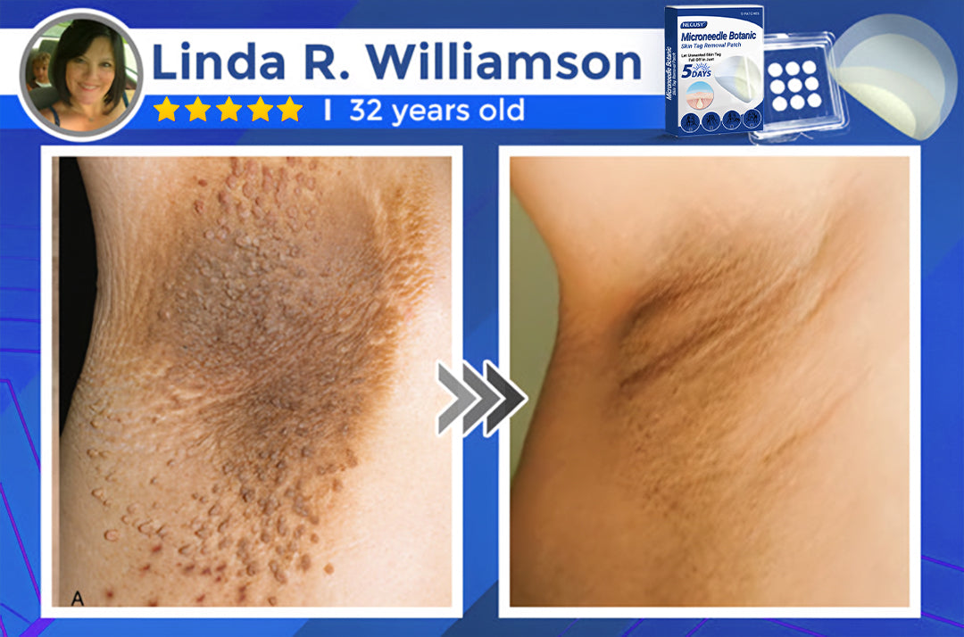 ✅Negusy™ MicroNeedle Botanic Skin Tag Removal Patches – 🇺🇸 Made in the USA | Fast, Painless, Plant-Powered