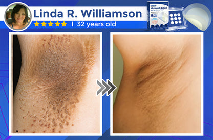 ✅Negusy™ MicroNeedle Botanic Skin Tag Removal Patches – 🇺🇸 Made in the USA | Fast, Painless, Plant-Powered