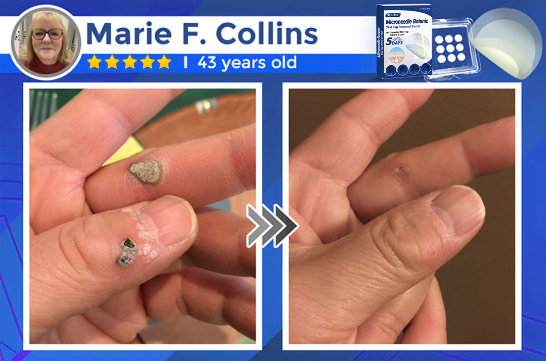 ✅Negusy™ MicroNeedle Botanic Skin Tag Removal Patches – 🇺🇸 Made in the USA | Fast, Painless, Plant-Powered