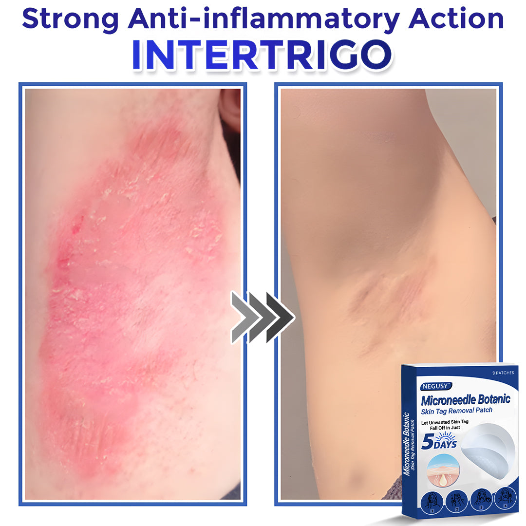 ✅Negusy™ MicroNeedle Botanic Skin Tag Removal Patches – 🇺🇸 Made in the USA | Fast, Painless, Plant-Powered