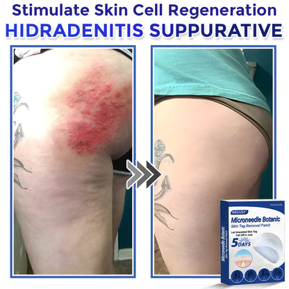 ✅Negusy™ MicroNeedle Botanic Skin Tag Removal Patches – 🇺🇸 Made in the USA | Fast, Painless, Plant-Powered