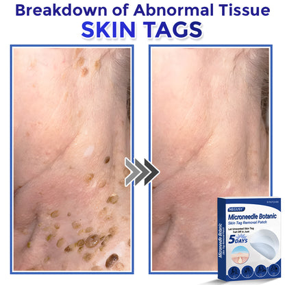 ✅Negusy™ MicroNeedle Botanic Skin Tag Removal Patches – 🇺🇸 Made in the USA | Fast, Painless, Plant-Powered