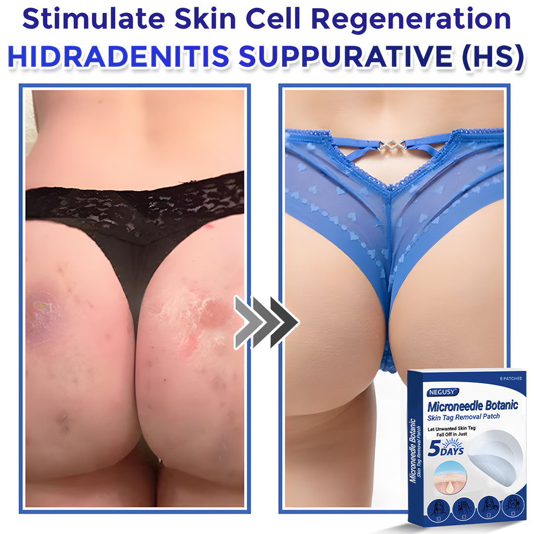 ✅Negusy™ MicroNeedle Botanic Skin Tag Removal Patches – 🇺🇸 Made in the USA | Fast, Painless, Plant-Powered