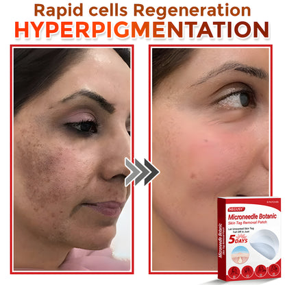 Negusy™ MicroNeedle Botanic Skin Tag Removal Patches – 🇺🇸 Made in the USA | Fast, Painless, Plant-Powered