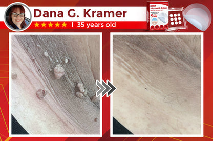 Negusy™ MicroNeedle Botanic Skin Tag Removal Patches – 🇺🇸 Made in the USA | Fast, Painless, Plant-Powered