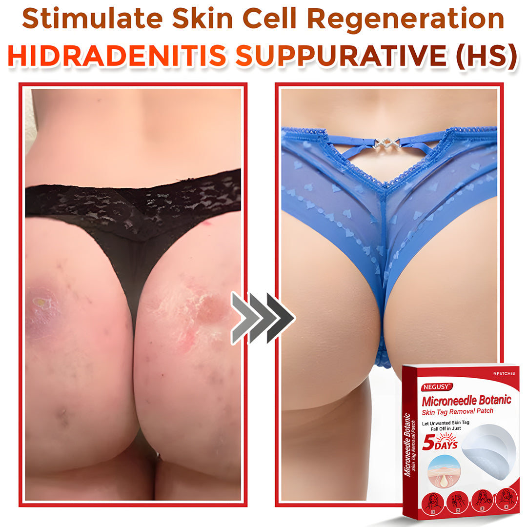 Negusy™ MicroNeedle Botanic Skin Tag Removal Patches – 🇺🇸 Made in the USA | Fast, Painless, Plant-Powered