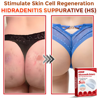 Negusy™ MicroNeedle Botanic Skin Tag Removal Patches – 🇺🇸 Made in the USA | Fast, Painless, Plant-Powered