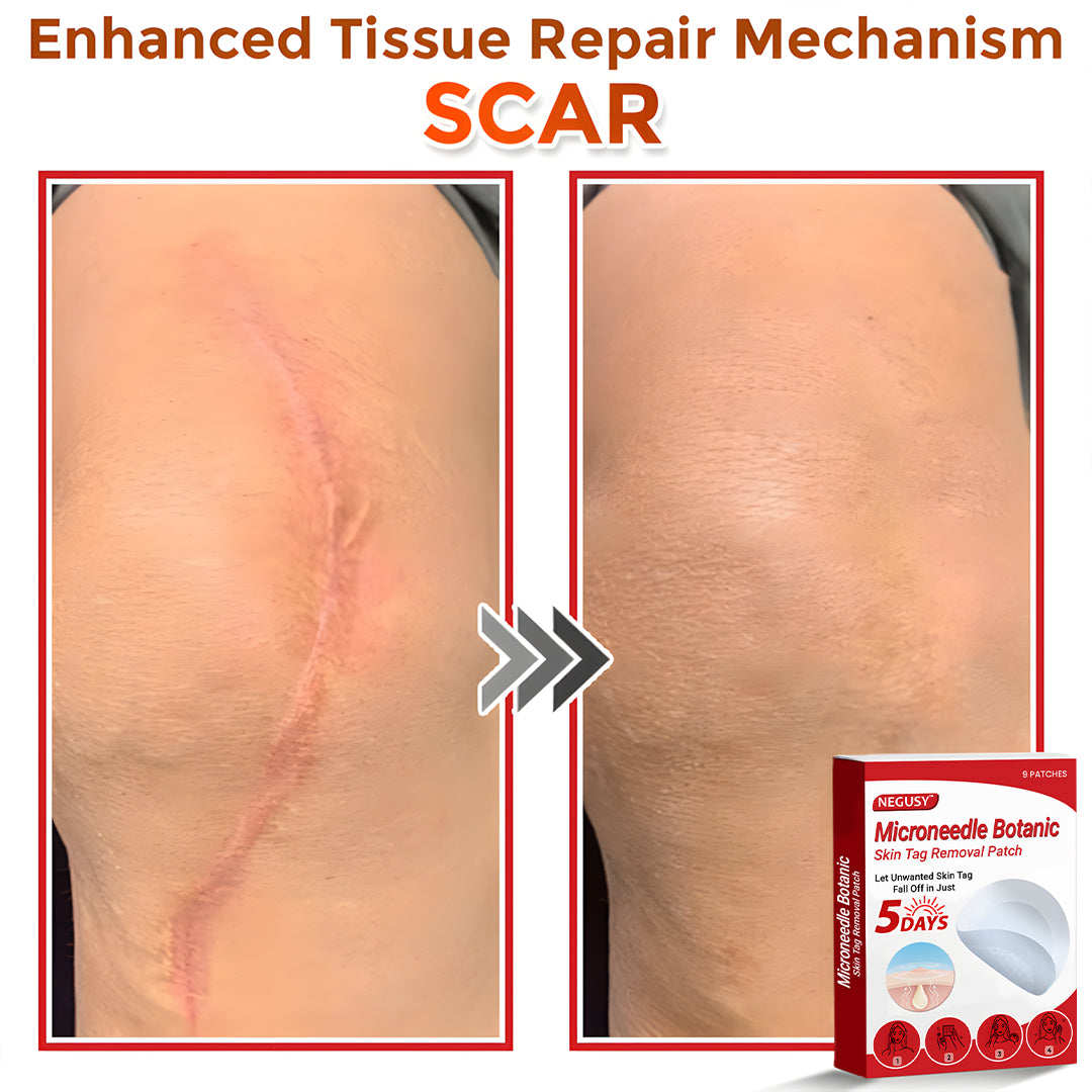 Negusy™ MicroNeedle Botanic Skin Tag Removal Patches – 🇺🇸 Made in the USA | Fast, Painless, Plant-Powered