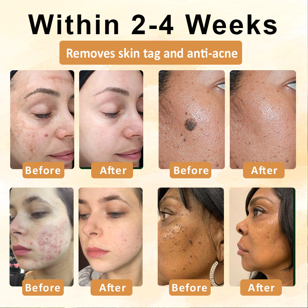 【🔥Last Day Promotion 45% OFF⚡】Seurico™ CastorBee Tag & Spots Peel-Off Mask