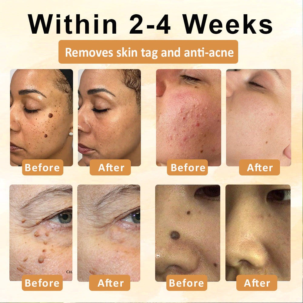 【🔥Last Day Promotion 45% OFF⚡】Seurico™ CastorBee Tag & Spots Peel-Off Mask