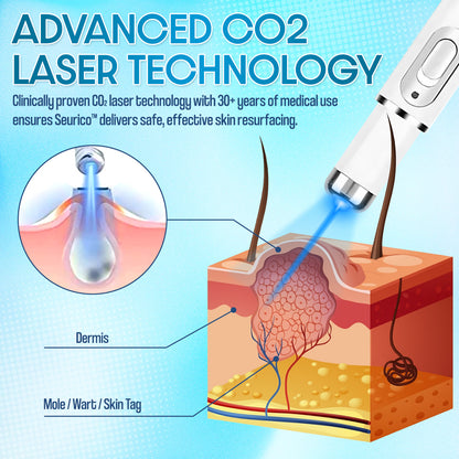 ✨Seurico™ Laser Pen - Non-invasive Mole and Wart Removal