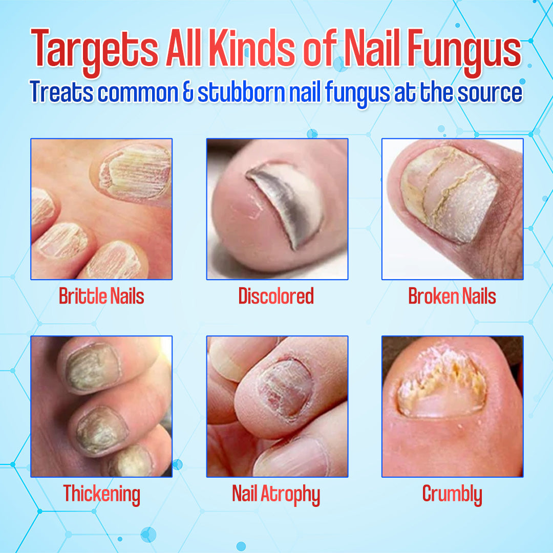 Zakdavi™ Anti-Fungal Nail Repair Patches — Say Goodbye to Nail Fungus in Days! 💅