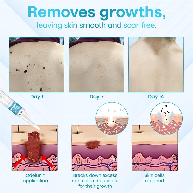 ✅ ODEIUN™ Professional Mole Removal Serum – Trusted Dermatological Formula 🩺