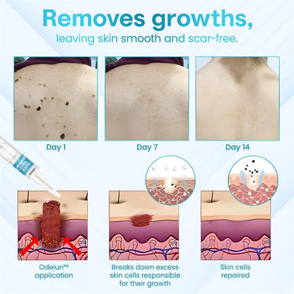 ✅ ODEIUN™ Professional Mole Removal Serum – Trusted Dermatological Formula 🩺
