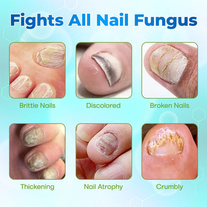 Lbmlbm® OnyxiGuard Fungal Repair Herbal Spray – 🌿 Natural Treatment for Healthy, Revitalized Skin & Nails ✨