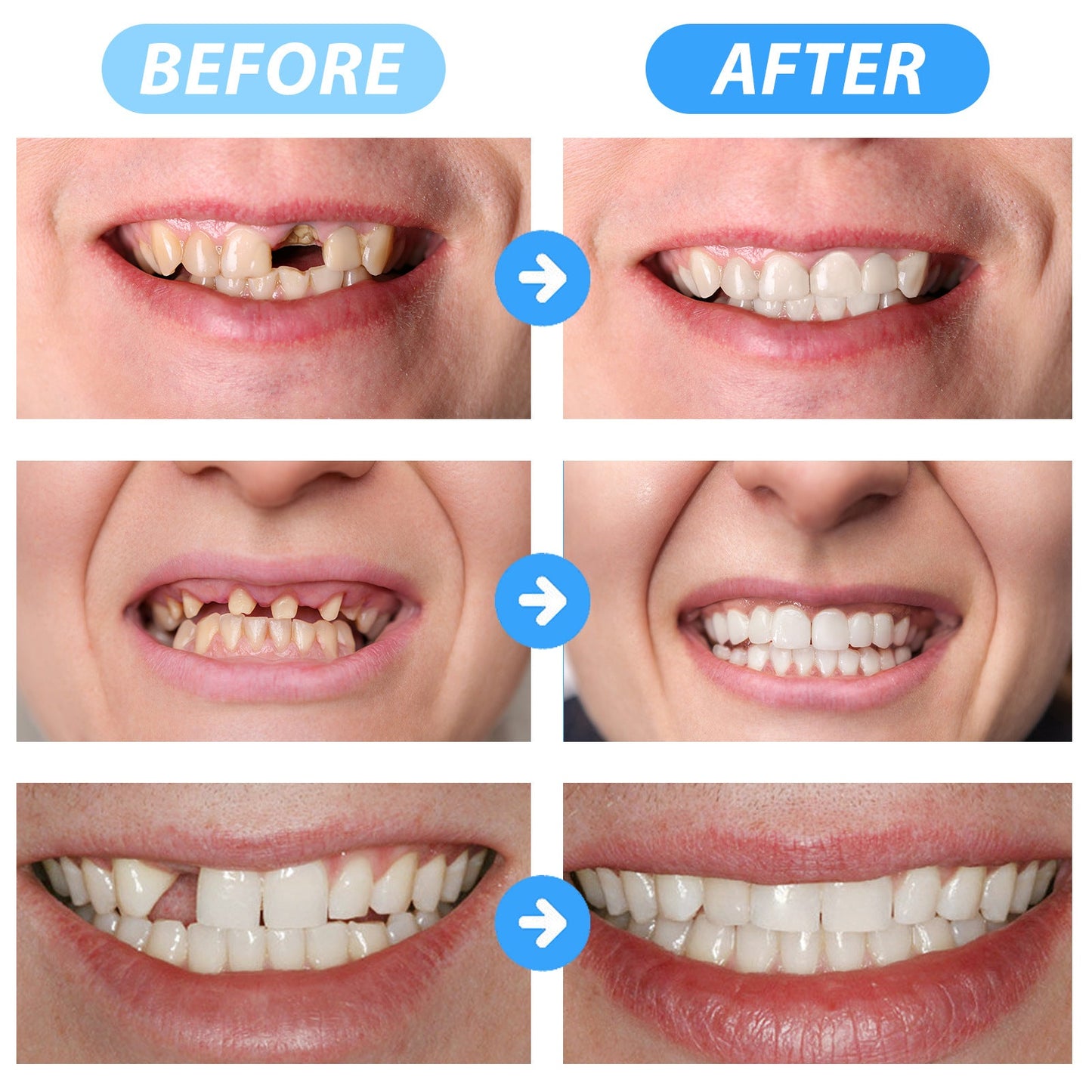 Seurico™ Instant Tooth Repair Gel – No Drills, No Pain, Fast at Home Fix!