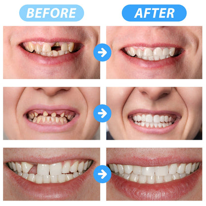 Seurico™ Instant Tooth Repair Gel – No Drills, No Pain, Fast at Home Fix!