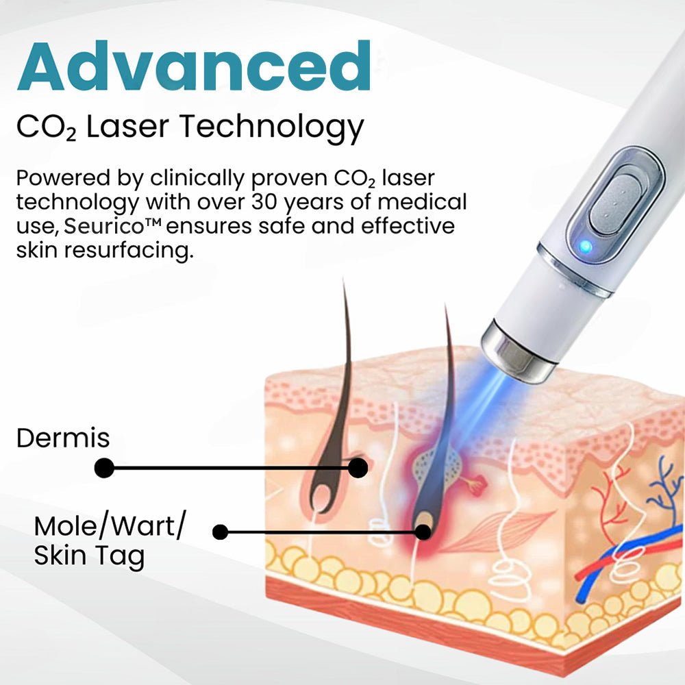 ✨Seurico™ Laser Pen - Non-invasive Mole and Wart Removal
