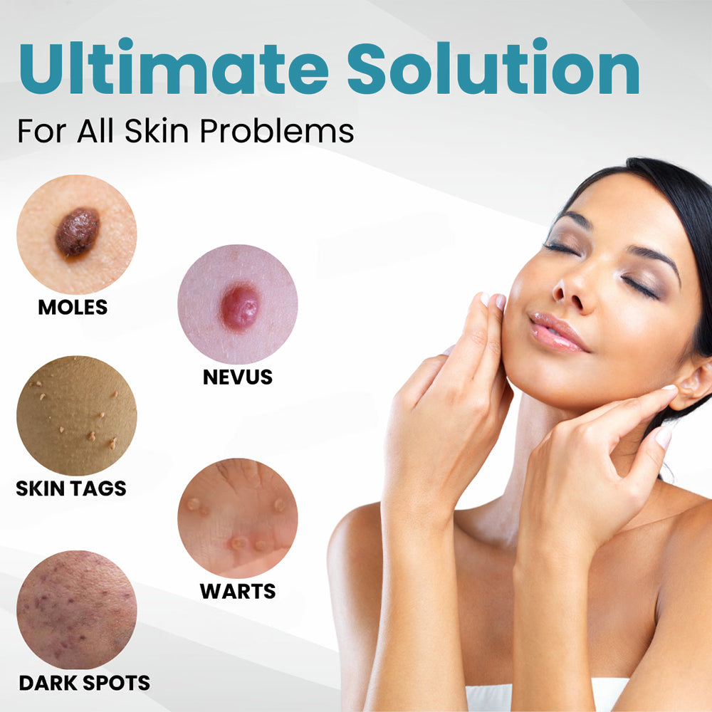 ✨Seurico™ Laser Pen - Non-invasive Mole and Wart Removal