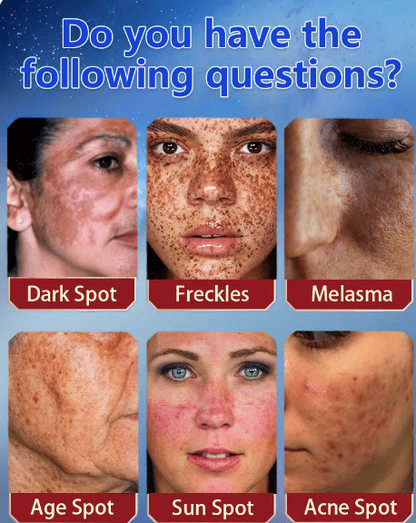 ✨ [Official Store] LBMLBM™ Blemish Removing Beauty Cream – Fade Dark Spots, Freckles & Wrinkles 💫 Restore a Radiant, Even-Toned Glow!