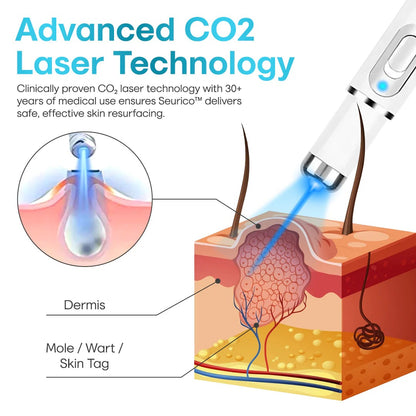 ✨Seurico™ Laser Pen - Non-invasive Mole and Wart Removal.