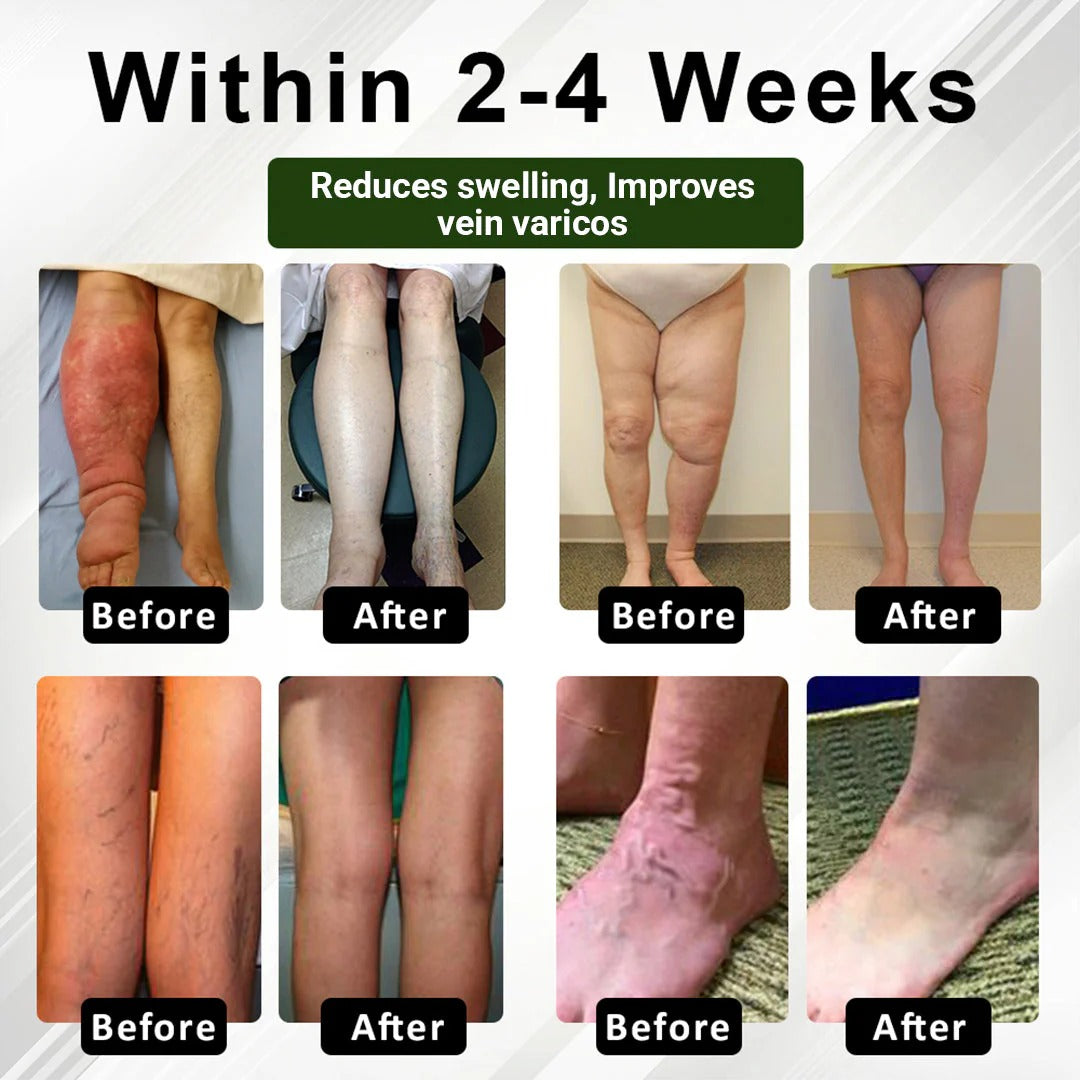 Zakdavi™ FluidEase Leg Therapy Cream | Reduce Swelling, Improve Circulation