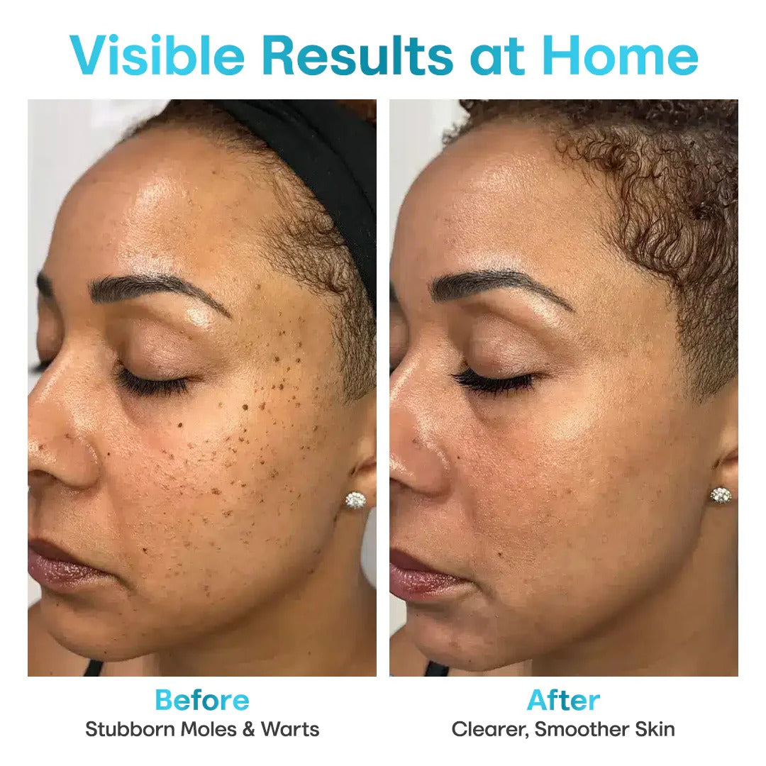 ✨Seurico™ Laser Pen - Non-invasive Mole and Wart Removal.