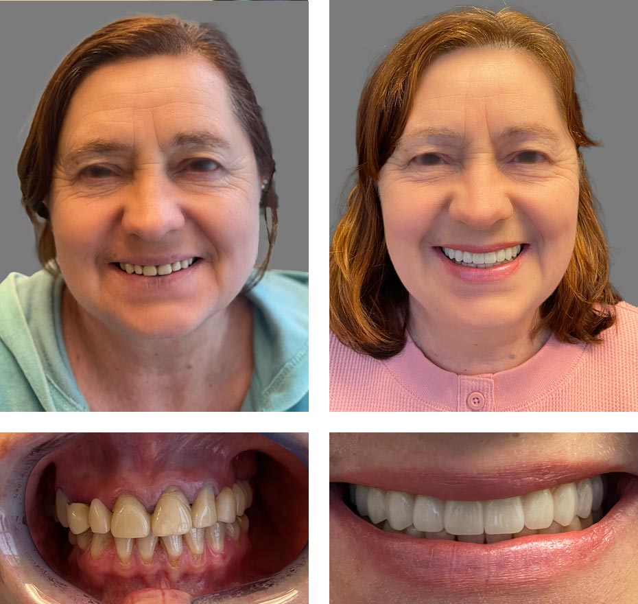 Seurico™ Instant Tooth Repair Gel – No Drills, No Pain, Fast at Home Fix!