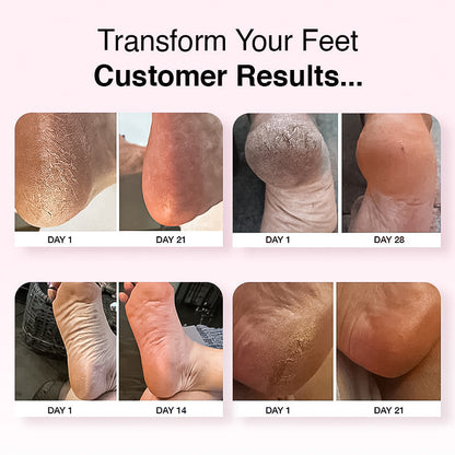 CalluSmooth™ Electric Foot Callus File