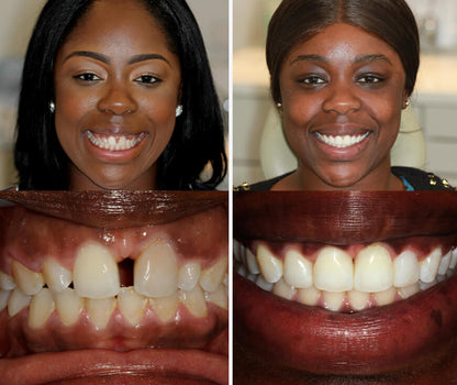 Seurico™ Instant Tooth Repair Gel – No Drills, No Pain, Fast at Home Fix!